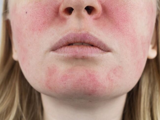 Rosacea Triggers And Treatment Options Dr Amna S Clinic