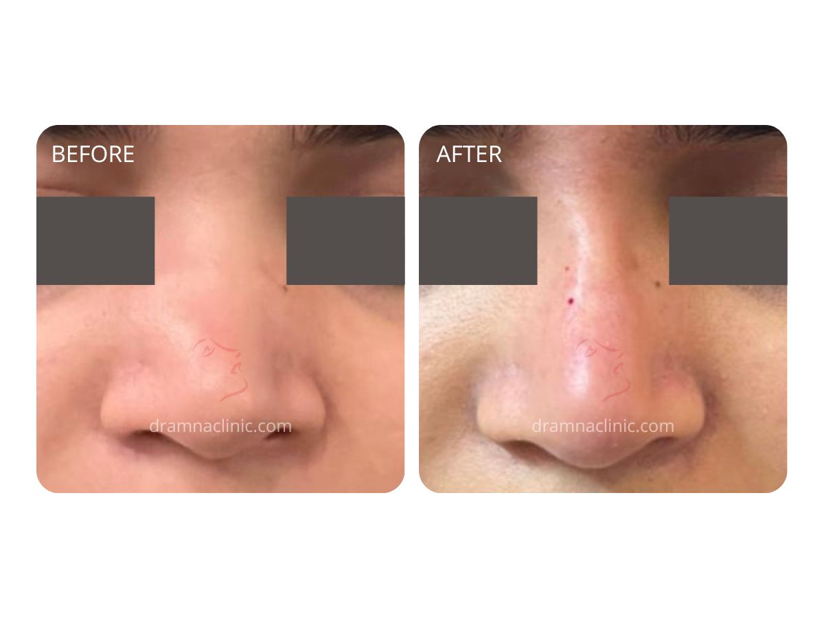 Liquid Rhinoplasty