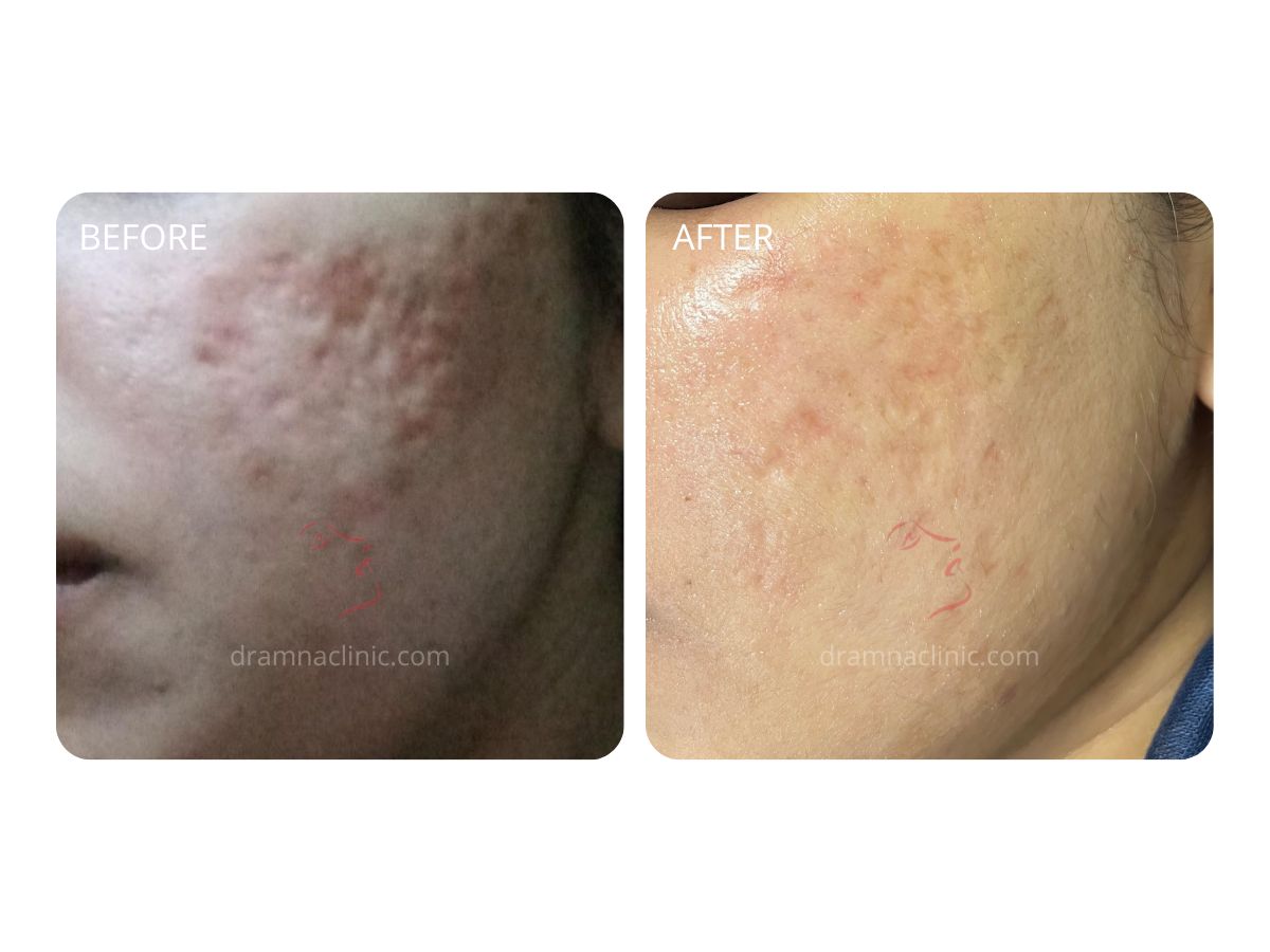 Acne Scars - Improvement in 1 Session