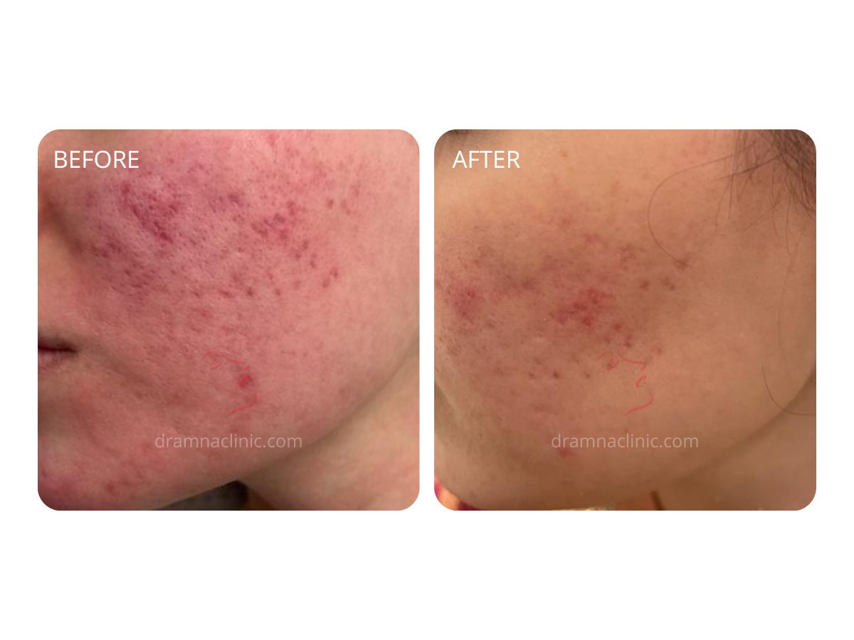 Acne Scars - Improvement in 2 Sessions