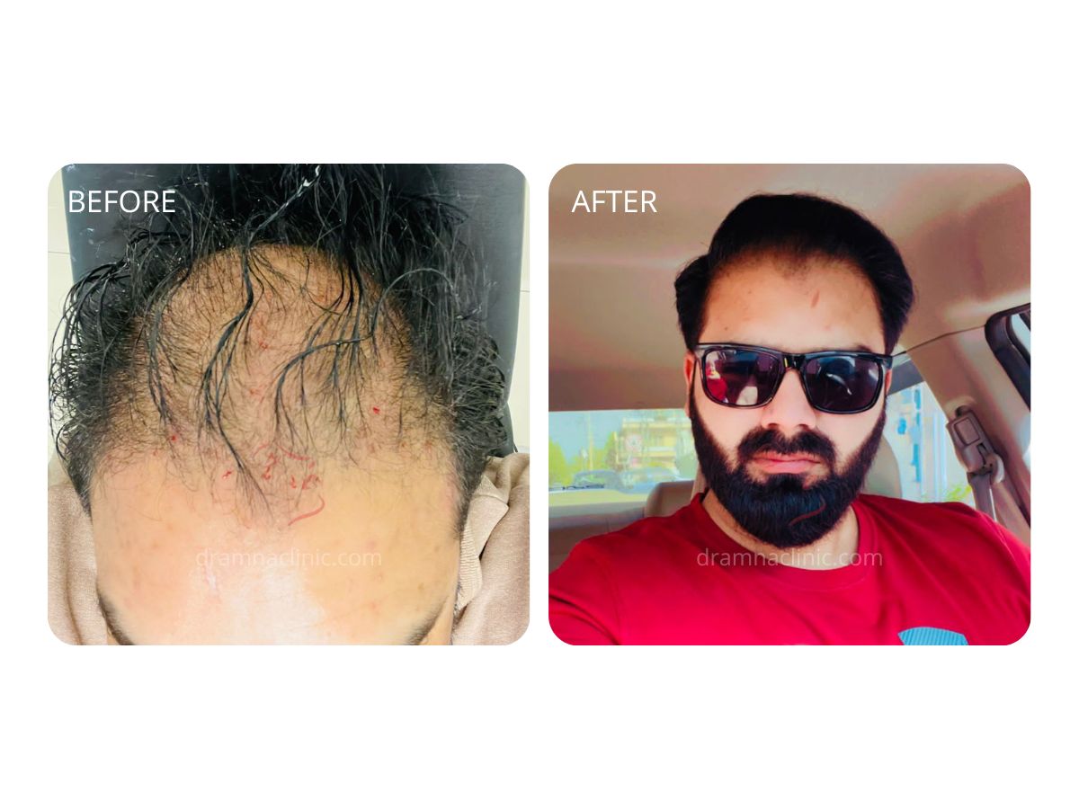 Hair PRP Therapy